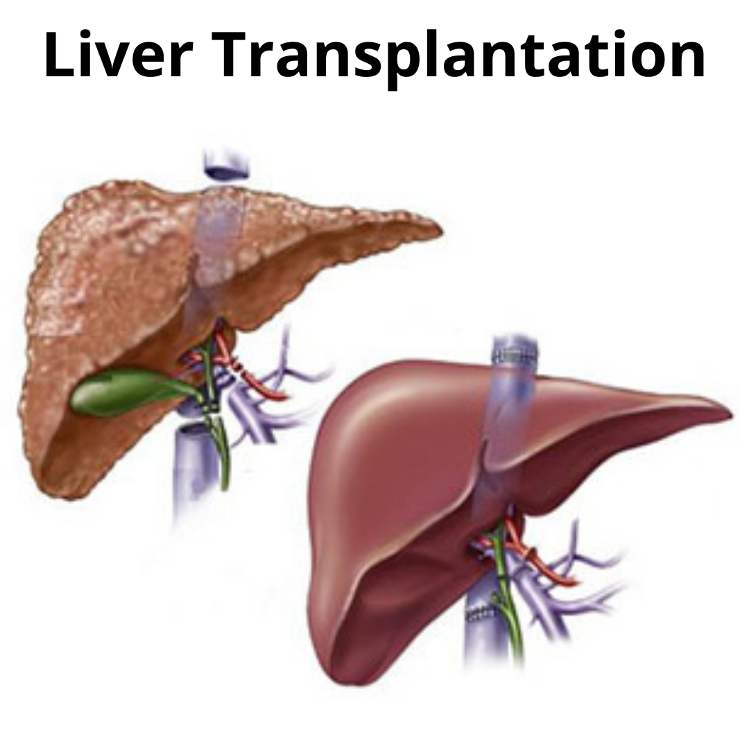 Best Liver Transplant Surgeon in Mumbai