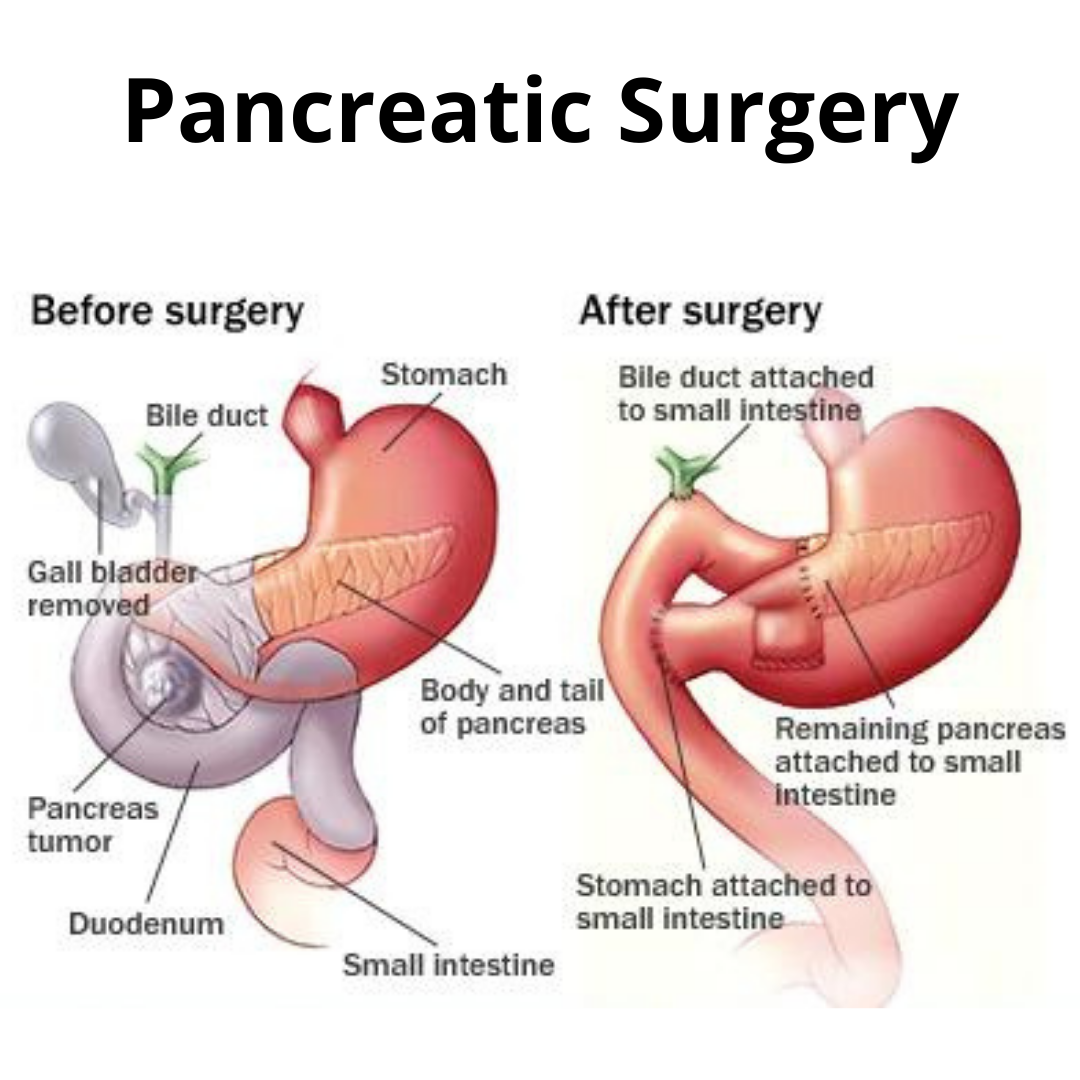 Pancreas Cancer Surgeon in Mumbai - Dr. Nanavati